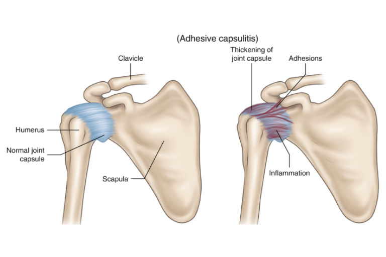 Adhesive Capsulitis