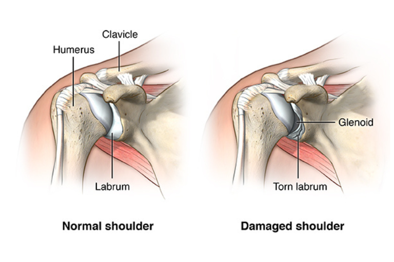 Shoulder Dislocation & Instability