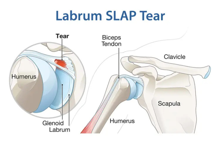 Slap & Labral tears