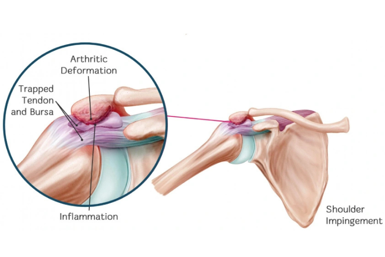 Shoulder Impingement Syndrome